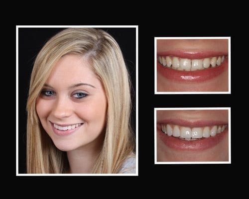 Riverhead Cosmetic Dentist Smile Gallery | Smile Makeovers Roslyn